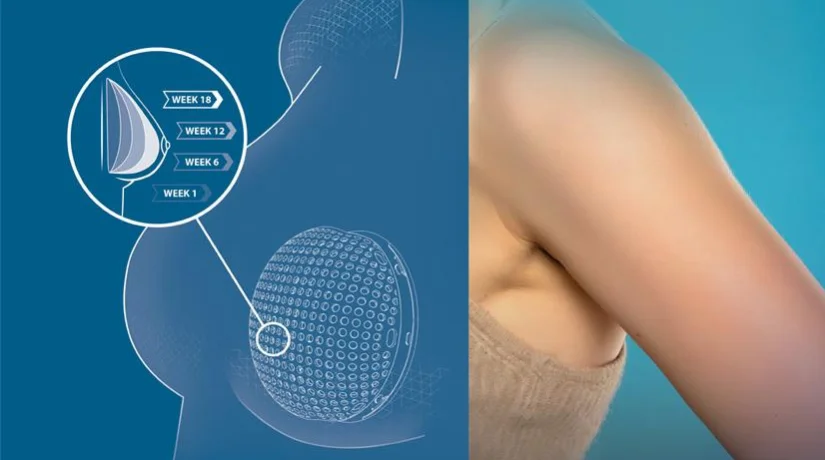 illustrating the mattisse implant - breast cancer treatment - dassault systemes blog